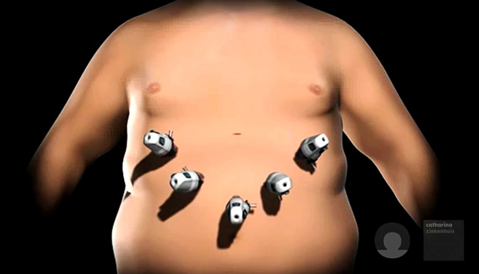 Gastric Sleeve in het Obesitascentrum Catharina Ziekenhuis