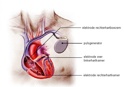 Biventriculaire ICD.jpg