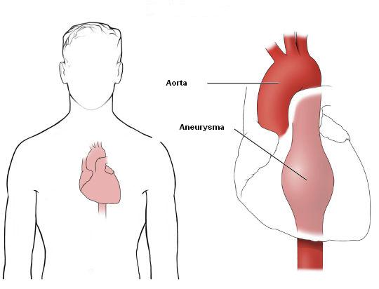 Aorta What is