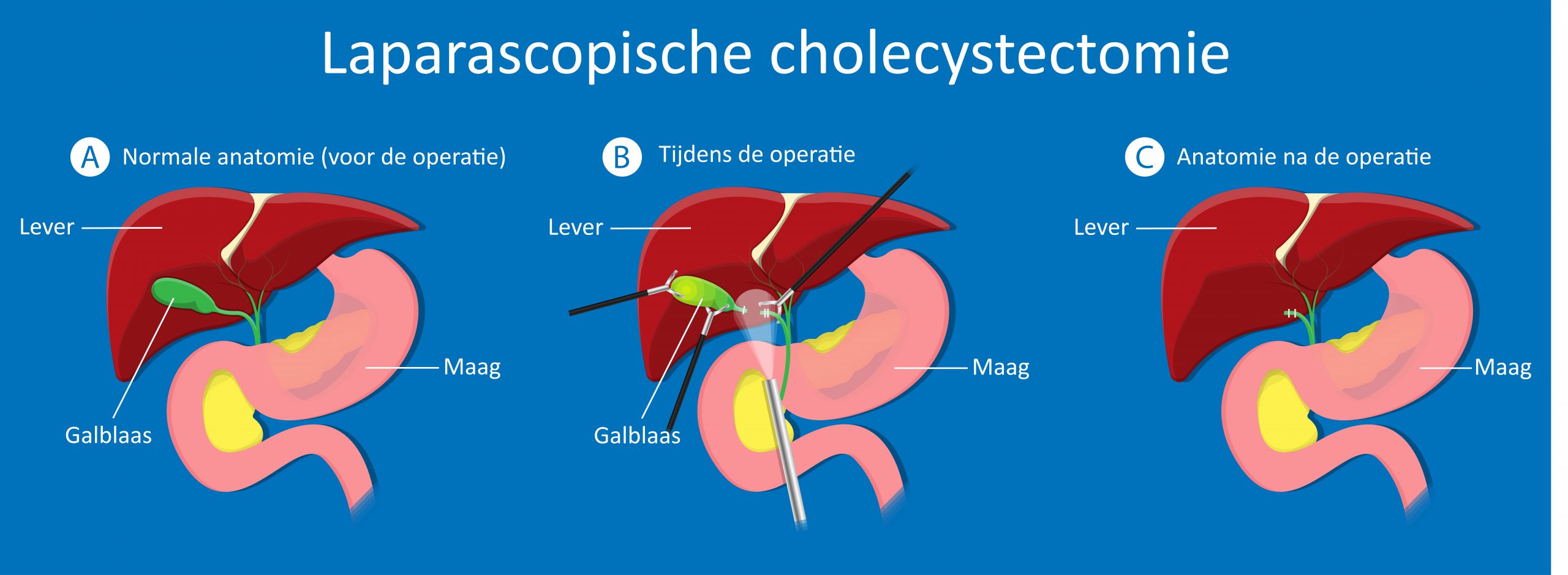 Laparascopische cholecystectomie.jpg