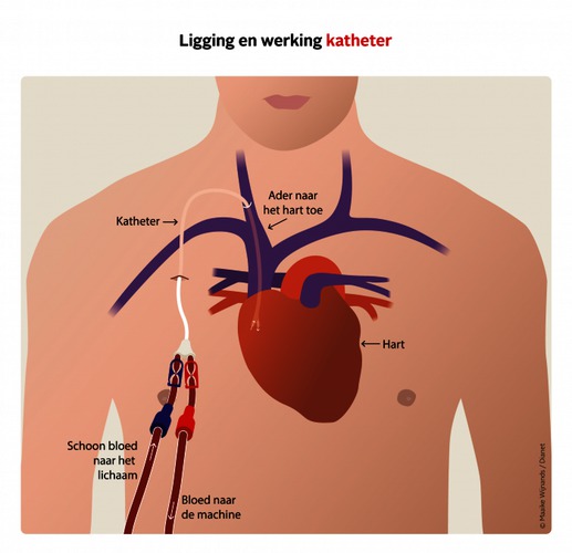 Ligging en werking katheter.png