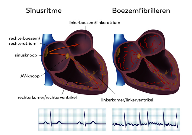 Sinusritme (links) en boezemfibrilleren (rechts)