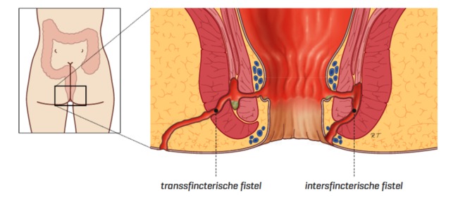 fistel-1.png
