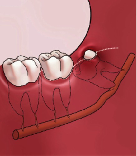 hoe lang duurt bloeden na kies trekken
