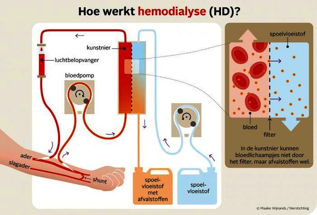 nieren hemodialyse.png