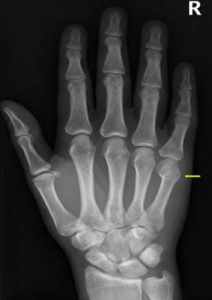 Metacarpal fracture 