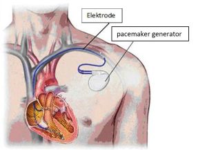Pacemaker generator vervangen (Folder) - Catharina Ziekenhuis