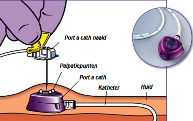 Port-a-cath