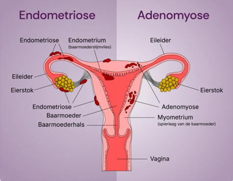 Afbeelding die het verschil tussen endometriose en adenomyose laat zien.